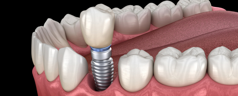 benefits of dental implants