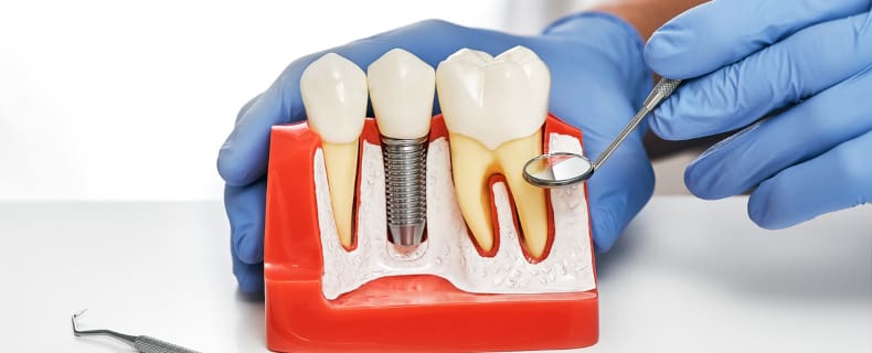 care for dental implant